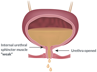 What Is Stress Urinary Incontinence?
